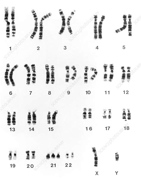 Karyotype Of Chromosomes In Downs Syndrome Stock Image M352 0002