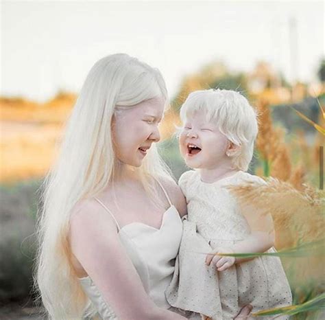 albino nedir albinizm nedir