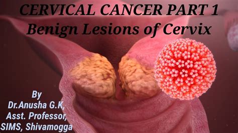 cervical cancer part 1 benign lesions of cervix the white army