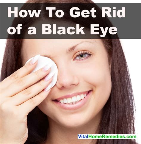 how to get rid of a black eye vital home remedies
