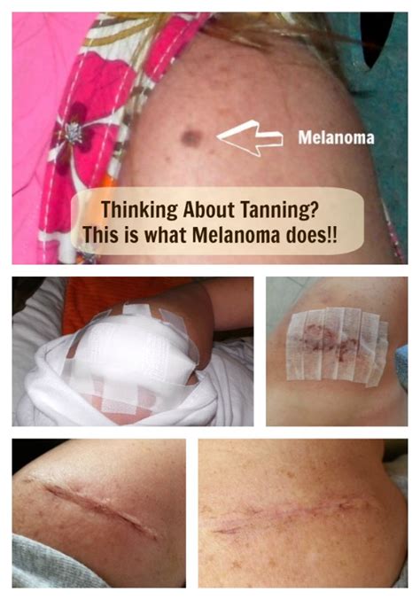 melanoma diagnosis    feel lucky melanoma resources