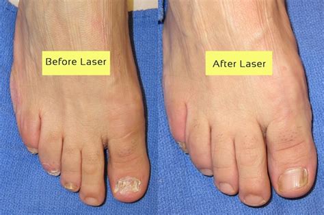 laser treatment  toenail fungus