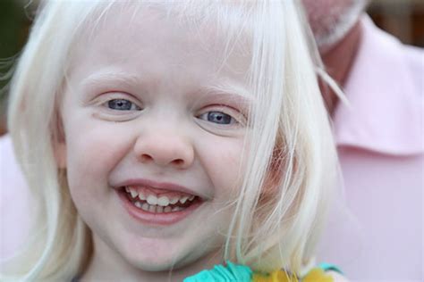 albino albinism  genetics types symptoms treatment