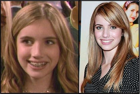 Emma Roberts Before And After Celebrities With Braces