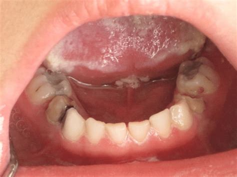 White Keratotic Plaques On The Floor Of The Mouth