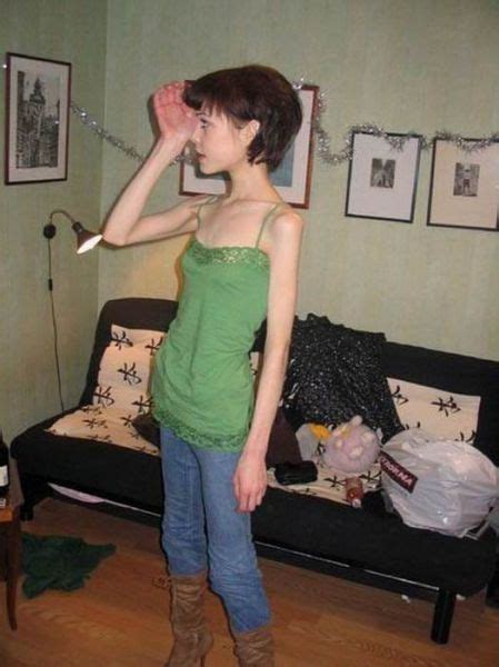 anorexic girls 17 pics