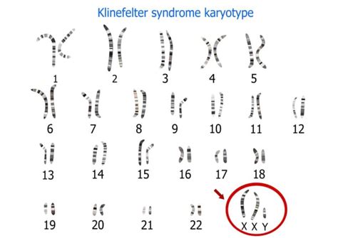 Klinefelter Syndrome Overview Causes Symptoms Treatment