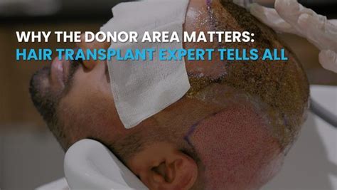 donor area matters hair transplant expert tells