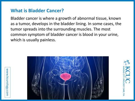 Ppt Bladder Cancer Causes Symptoms And Signs Powerpoint Presentation