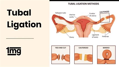 bilateral tubal ligation