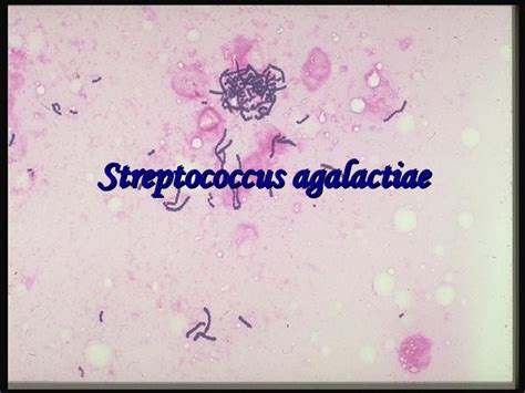 Streptococcus Agalactiae Drbeckmann