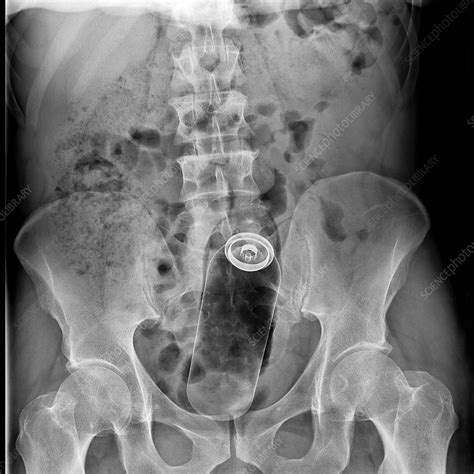 Foreign Body In Rectum X Ray Stock Image C038 6646 Science Photo