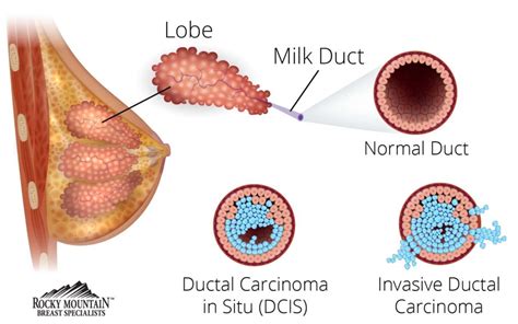 Causes Of Dcis And Breast Cancer Eye Cancer