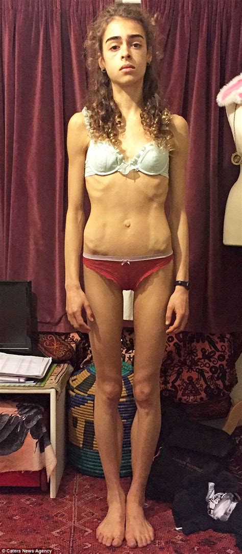 Four Stone Anorexic Ballet Dancer Who Survived On Just 140