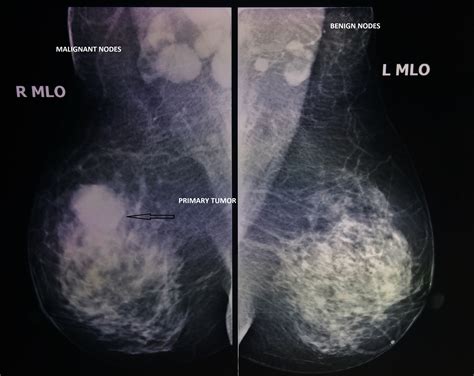 Inflammatory Breast Cancer Brazil Pdf Ppt Case Reports Symptoms
