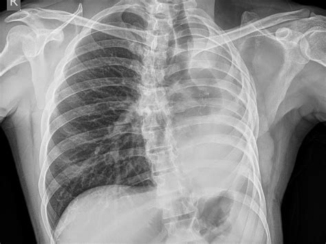 pneumonectomy cxr sumers radiology blog