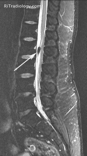 rit radiology lipoma  filum terminale