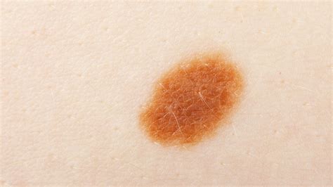 Worried About Skin Cancer How To Tell If Your Mole Is Cancerous