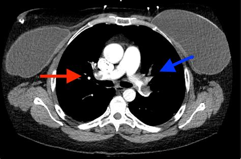 cureus bilateral pulmonary emboli  dabigatran