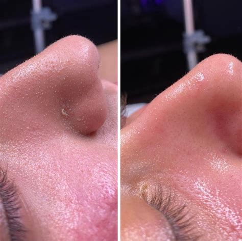 hydrafacials  remarkable  dry flutters lash spa