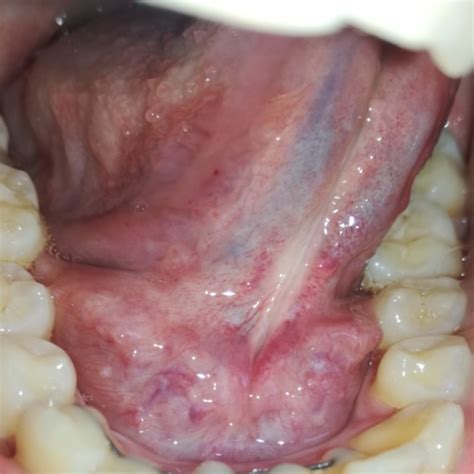 Mouth Lesions Oral Cancer Std Syphilis Oral And Dental