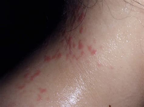 healthool itchy neck pictures symptoms treatment rash