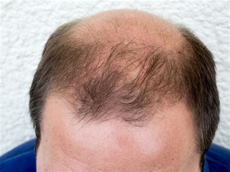 Dht Dihydrotestosterone What Is Dht S Role In Baldness