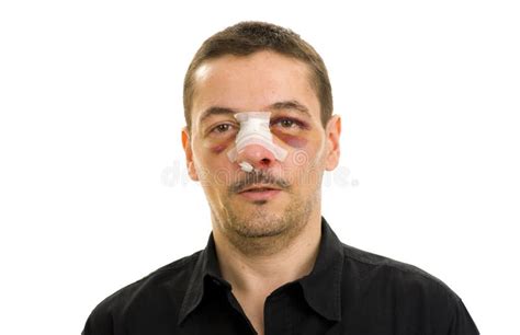 broken nose post operation stock image image  isolated