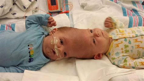 conjoined twins finally separated after 16 hour surgery