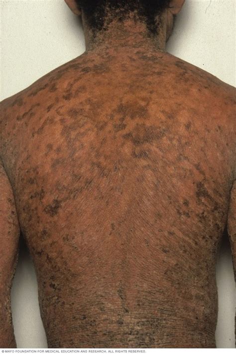 ichthyosis vulgaris symptoms and causes mayo clinic