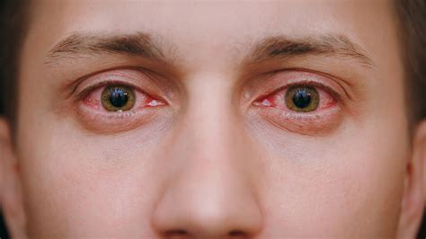allergic conjunctivitis   protect  eyes  blog
