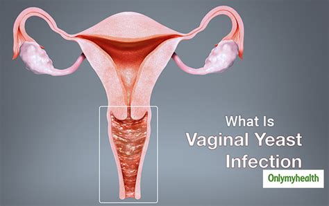 vaginal yeast infection    risks  doctor