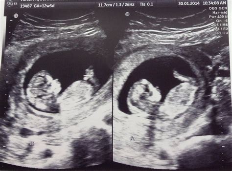 fraternal twins ultrasound  weeks twins pinterest fraternal