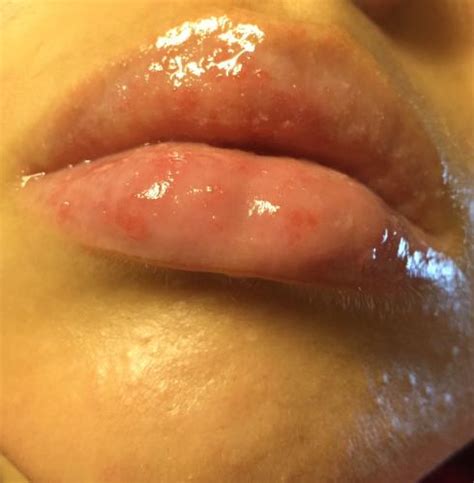 Please Help Tiny Bumps Blisters On Lips Day 15 Of Accutane