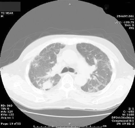 Ct Chest Of The Patient Shows Right Upper Lobe Mass And Bilateral