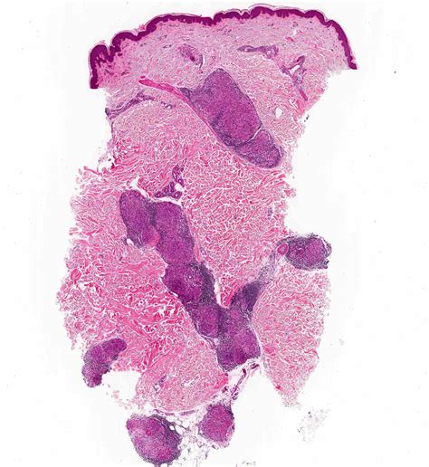 Pathology Outlines Sarcoidosis