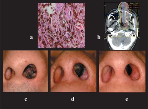 Malignant Melanoma In The Left Nasal Cavity A Histolo