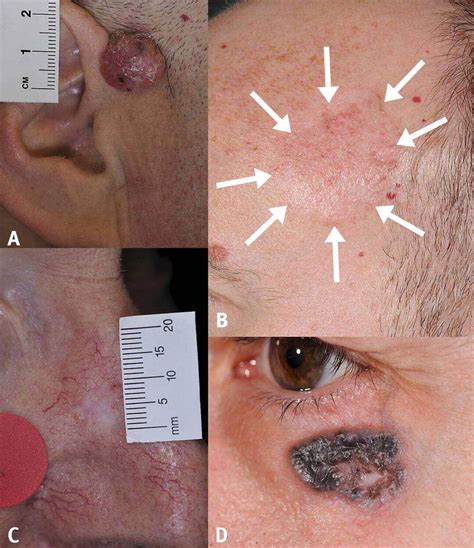 skin cancer scars  face