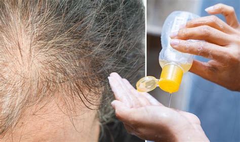 Hair Loss Treatment Ketoconazole Shampoo May Promote Hair Growth