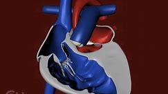 The Structure of a Heart with Hypoplastic Left Heart Syndrome (HLHS) - CHOP