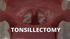 What is Tonsillectomy?