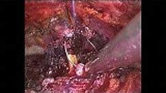 Zespolenie pęcherza z cewką moczową - pierwszy szew - laparoskopowa radykalna prostatektomia • Film • MEDtube.pl