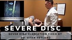 Severe Disc Herniation Patient Fixed by Dr Ryan Hetland | Gonstead Chiropractor in Minnesota