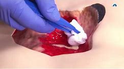 How to Effectively Cleanse and Debride a Wound | Wound Cleansing and Debridement | Ausmed Education