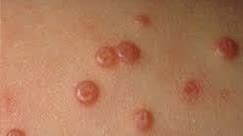 how to get rid of molluscum contagiosum at home