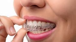 Clear aligners - Lapointe Dental Centres