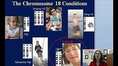 The Chromosome 18 Conditions