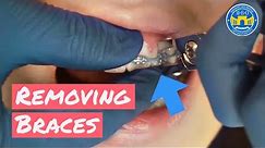 Process of Removing Braces