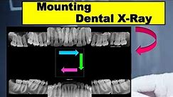 Dental X-Ray Full Mouth Mounting (FMX)