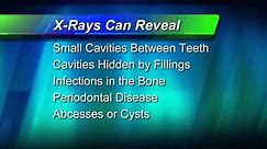Why X-Ray?